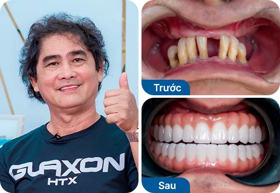 Chú Đình Phú trồng răng implant All-on-4 hàm trên, All-on-4 hàm dưới tại nha khoa I-Dent.