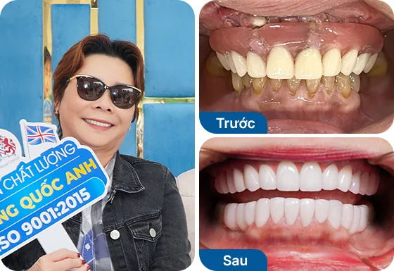 Cô Lệ Hằng trồng răng Implant All on 6 hàm trên tại nha khoa I-Dent.