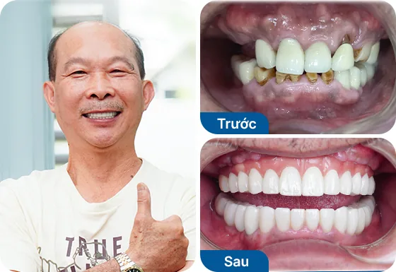 Chú Phát Lý trồng răng Implant All-on-4 tại nha khoa I-Dent.