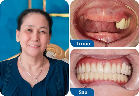 Cô Thanh Hương trồng răng Implant All on 4 hàm dưới tại nha khoa I-Dent.