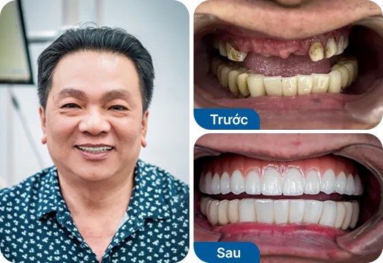 Chú Thanh Tùng trồng răng Implant All-on-5 tại nha khoa I-Dent.