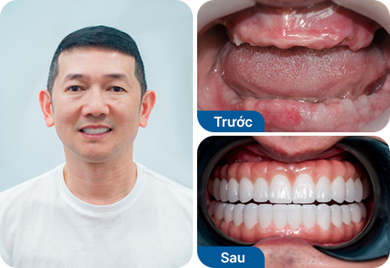 Chú Trọng Tâm cấy implant toàn hàm 2 hàm All-on-5 tại nha khoa I-Dent.