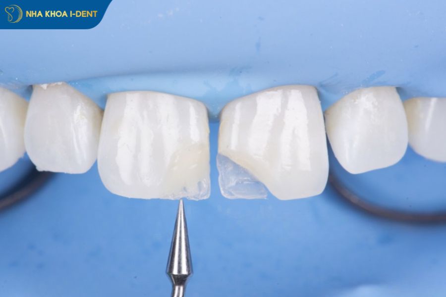 vật liệu trám răng composite