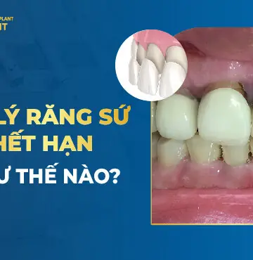 Xử Lý Răng Sứ Hết Hạn Như Thế Nào?