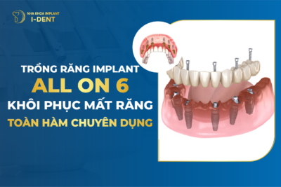 implant all on 6