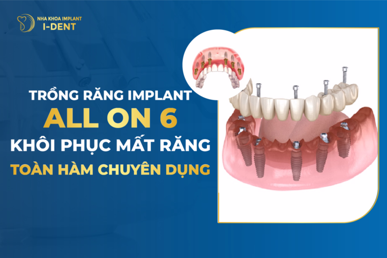 implant all on 6