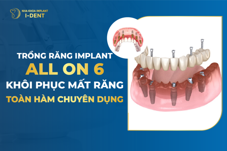 Trồng Răng Implant All On 6 – Khôi Phục Mất Răng Toàn Hàm Chuyên Dụng