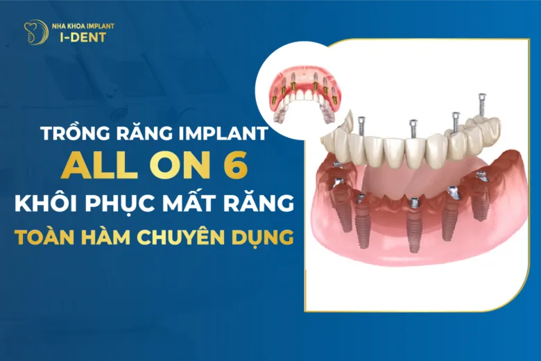 implant all on 6