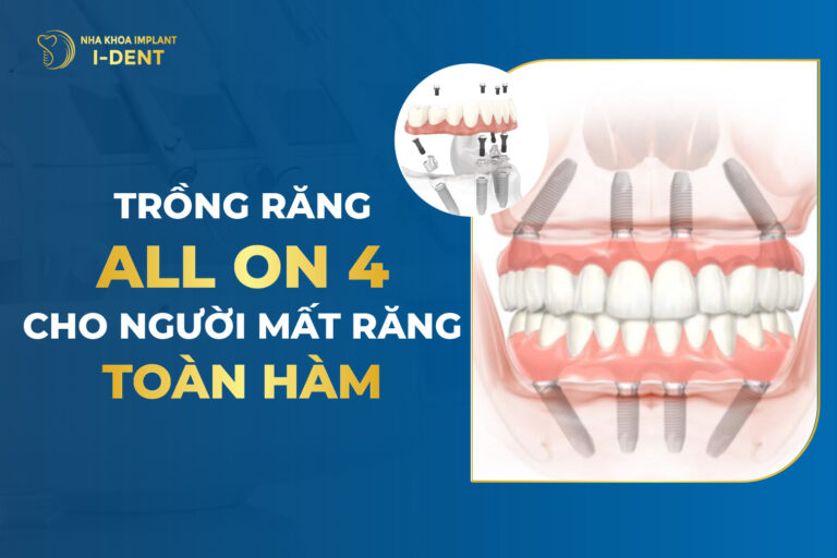cấy ghép implant all on 4