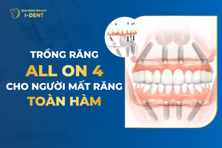 cấy ghép implant all on 4