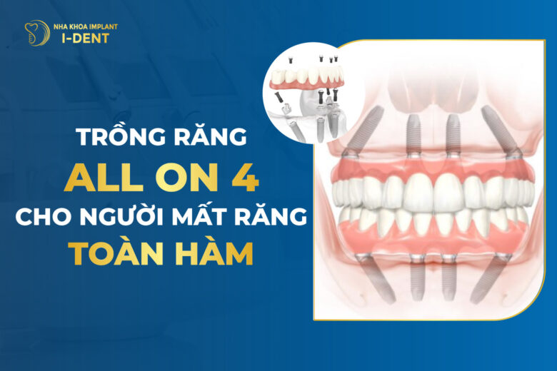 Trồng Răng Implant All On 4 Cho Người Mất Răng Toàn Hàm