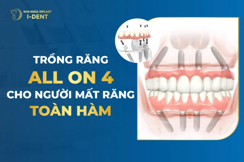 cấy ghép implant all on 4