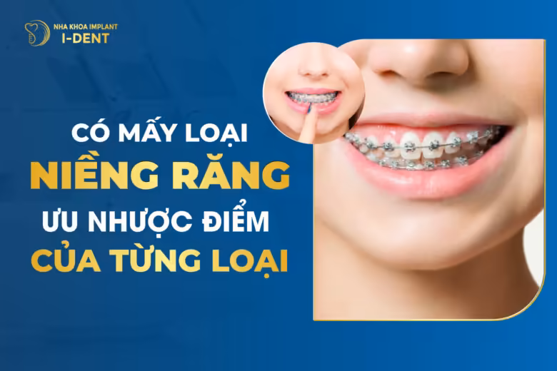 Có Mấy Loại Niềng Răng? Ưu Nhược Điểm Của Từng Loại?