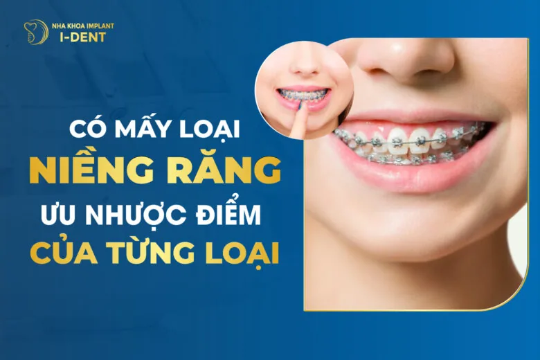 Có Mấy Loại Niềng Răng? Ưu Nhược Điểm Của Từng Loại?