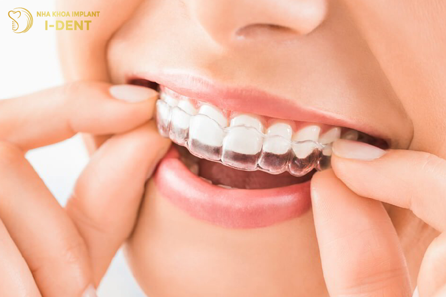 Niềng răng Invisalign có tính thẩm mỹ cao khi không bị lộ niềng