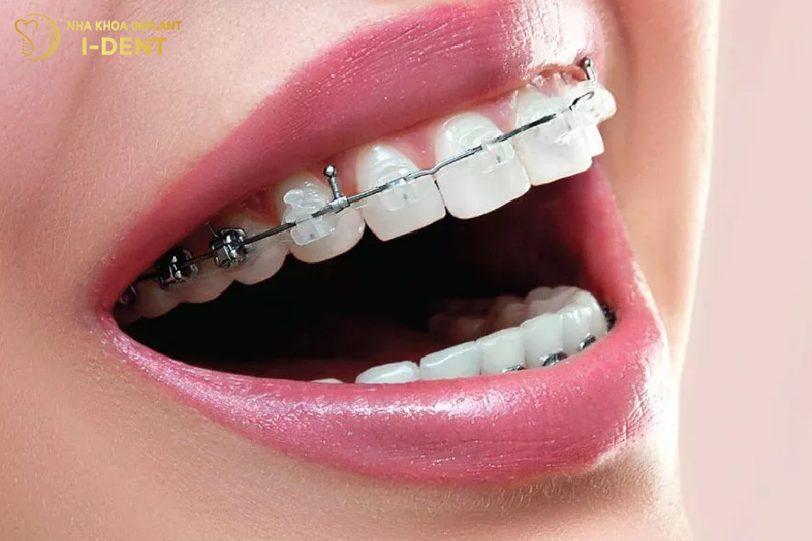 Niềng răng giúp bảo tồn cấu trúc men răng tối đa