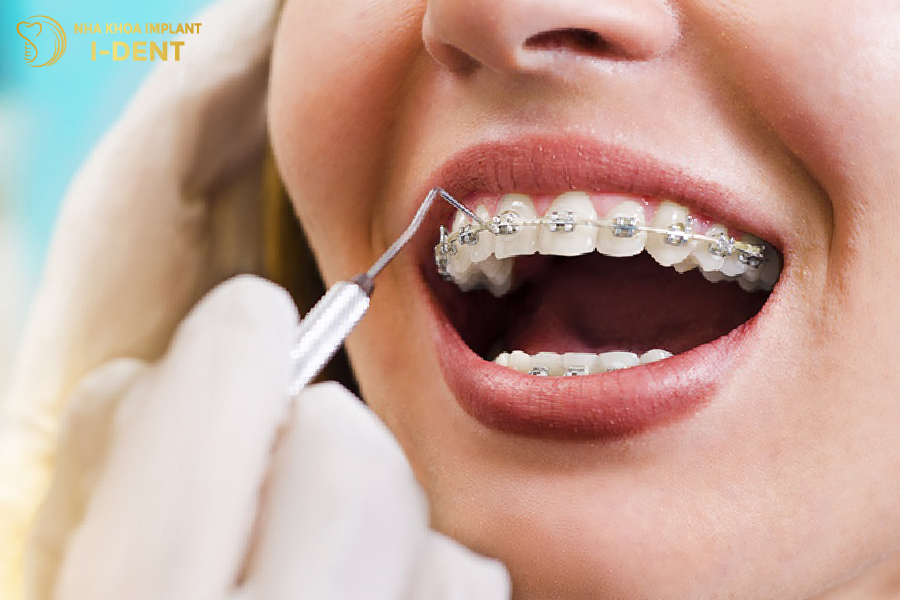 Niềng răng mắc cài kim loại khắc phục tốt những vấn đề về sai lệch khớp cắn