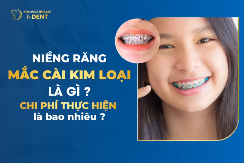 Nieng-Rang-Mac-Cai-Kim-Loai-La-Gi-Chi-Phi-Thuc-Hien-Bao-Nhieu