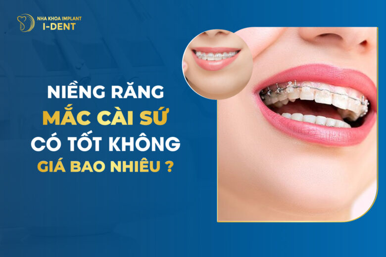 Niềng Răng Mắc Cài Sứ Giá Bao Nhiêu?