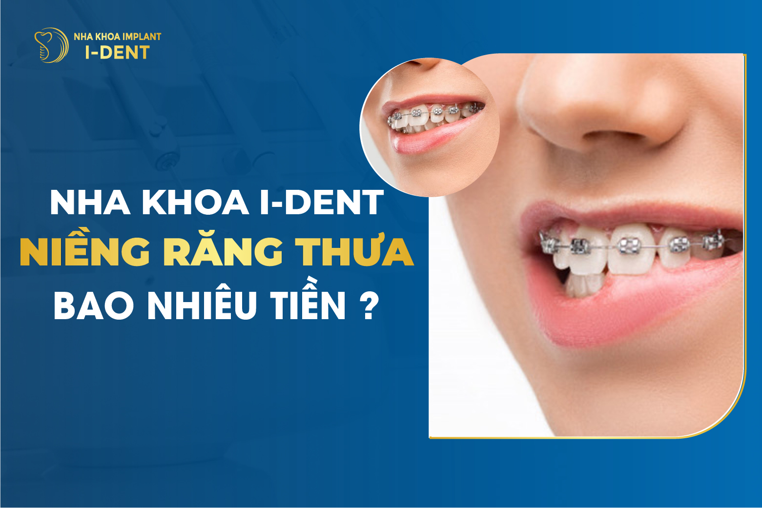Thông tin về niềng răng thưa và chi phí tại Việt Nam