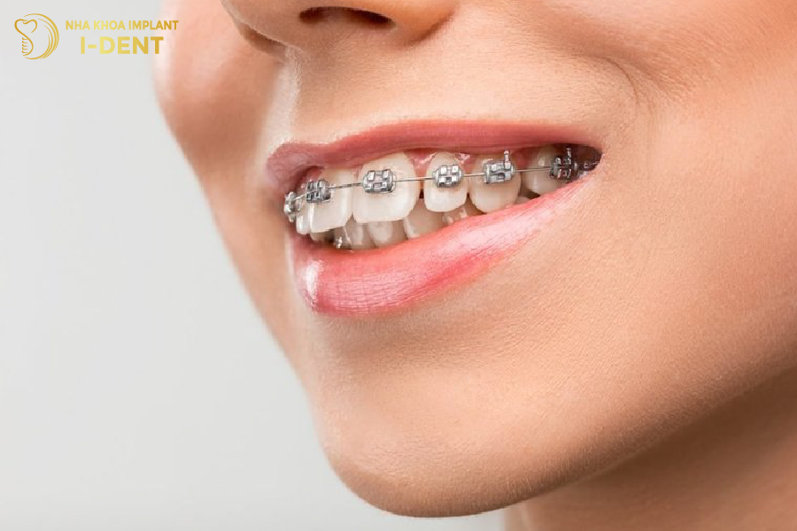 Niềng răng thưa là giải pháp bảo tồn cấu trúc răng