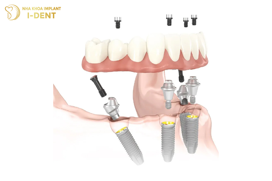 Phương án All On 4 chỉ cần đặt 4 trụ Implant, hạn chế tác động đến xương hàm