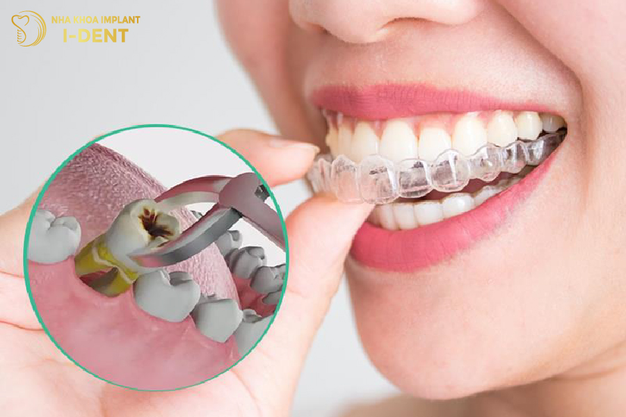 Thông thường niềng Invisalign chỉ cần nhổ bỏ răng số 8 (răng khôn)