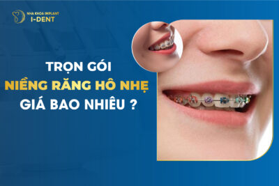 Trọn Gói Niềng Răng Hô Giá Bao Nhiêu?