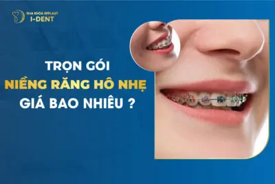 Trọn Gói Niềng Răng Hô Giá Bao Nhiêu?
