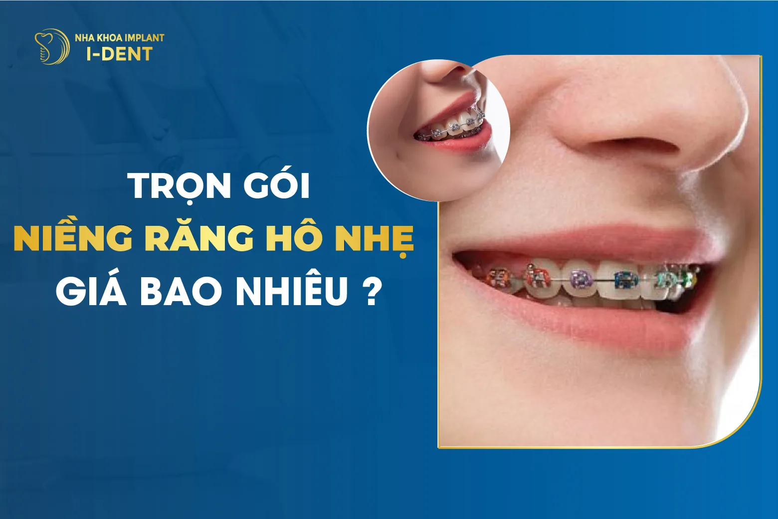 Trọn Gói Niềng Răng Hô Giá Bao Nhiêu?
