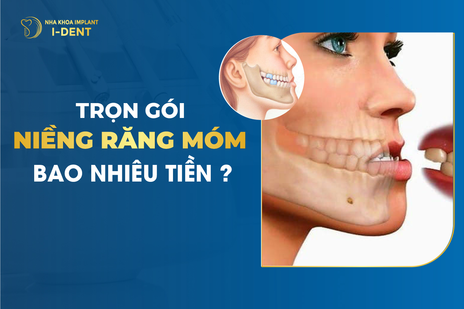 Thông tin về niềng răng móm và chi phí tại Việt Nam