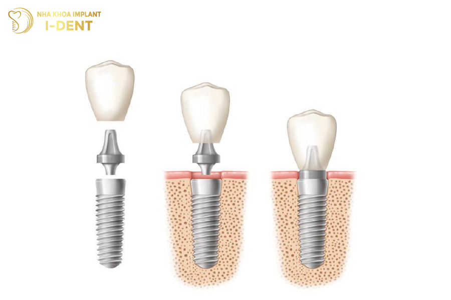 Trồng răng Implant là phương án khôi phục răng mất tiên tiến nhất