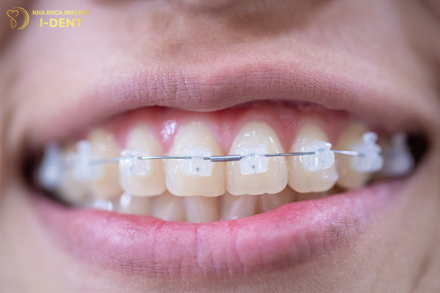 Niềng răng mắc cài sứ tự đóng