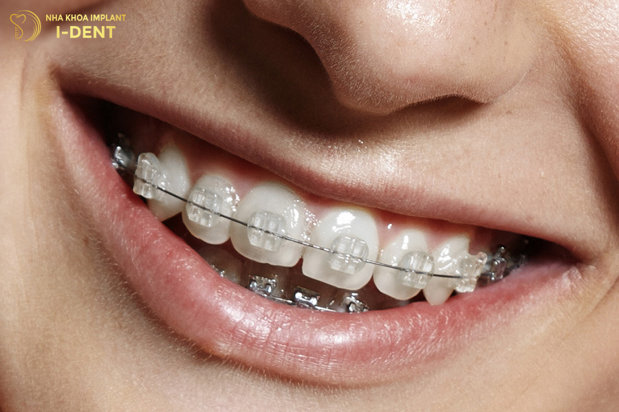 Niềng răng mắc cài sứ
