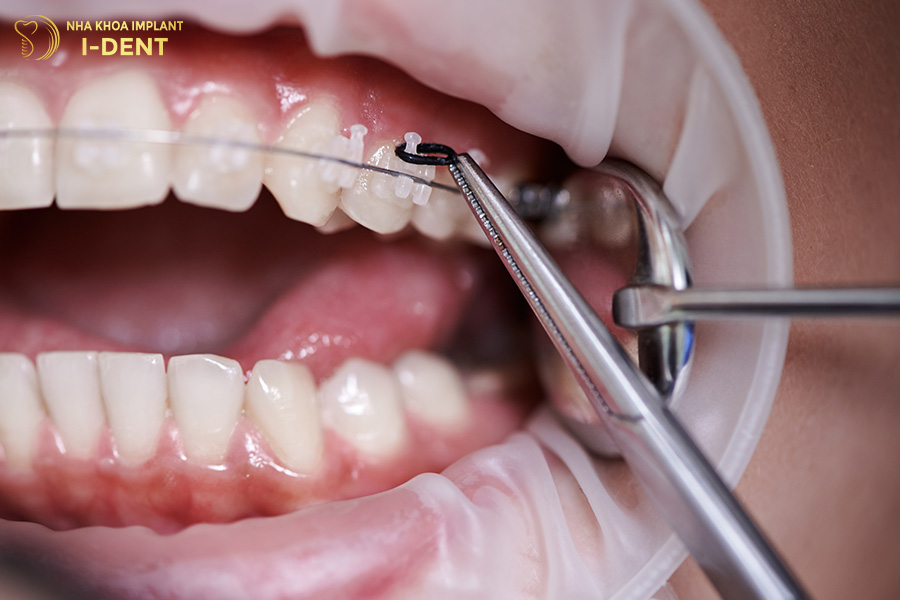 Niềng răng mắc cài sứ thường