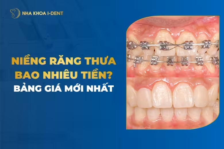 niềng răng thưa bao nhiêu tiền
