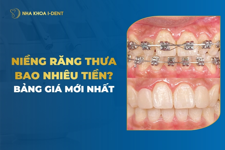 Niềng Răng Thưa Bao Nhiêu Tiền? Chi Phí Mới Nhất
