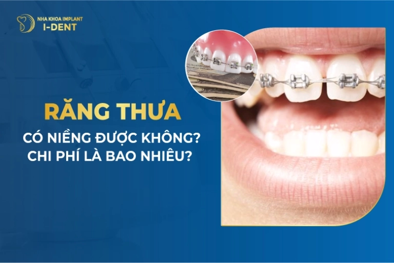 Răng Thưa Có Niềng Được Không? Chi Phí Là Bao Nhiêu?