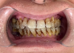 CHÍ BÌNH Trước khi làm răng