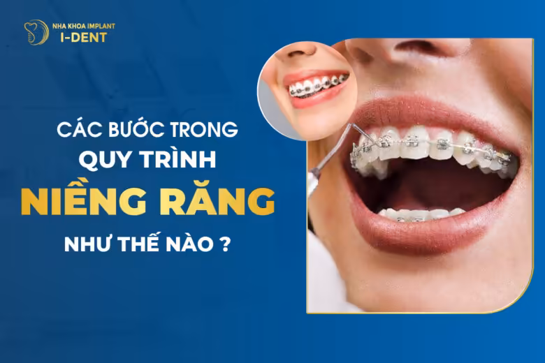 Các Bước Trong Quy Trình Niềng Răng Như Thế Nào?