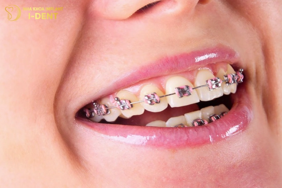 Các tình trạng răng khuyến khích nên niềng răng