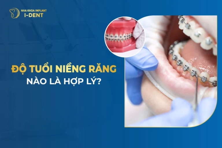 Độ Tuổi Niềng Răng Nào Là Hợp Lý