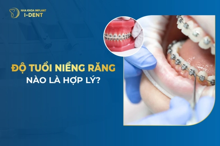 Độ Tuổi Niềng Răng Nào Là Hợp Lý