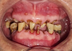 NGUYỄN HẢI Trước khi làm răng