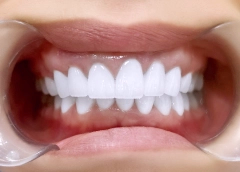 Sau khi làm răng tại nha khoa i-dent