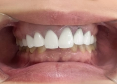 Trước khi làm răng tại nha khoa i-dent