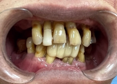 NGUYỄN NỐP Trước khi làm răng
