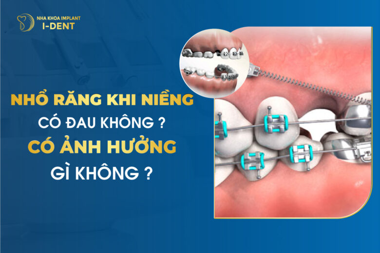 Nhổ Răng Khi Niềng Có Đau Không? Có Ảnh Hưởng Gì Không?