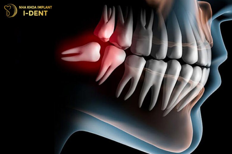 Tại Sao Cần Nhổ Răng Khi Niềng Và Có Ảnh Hưởng Gì Không?