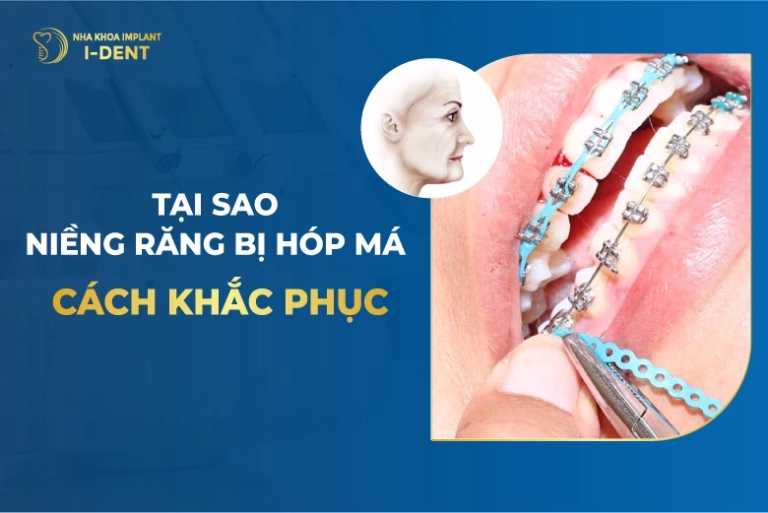 Niềng răng bị hóp má? Cách khắc phục
